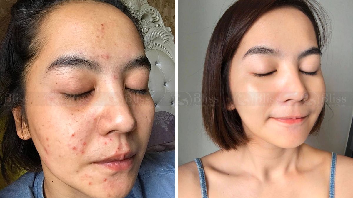 tiem-mesocell-extra-tri-mun-tham