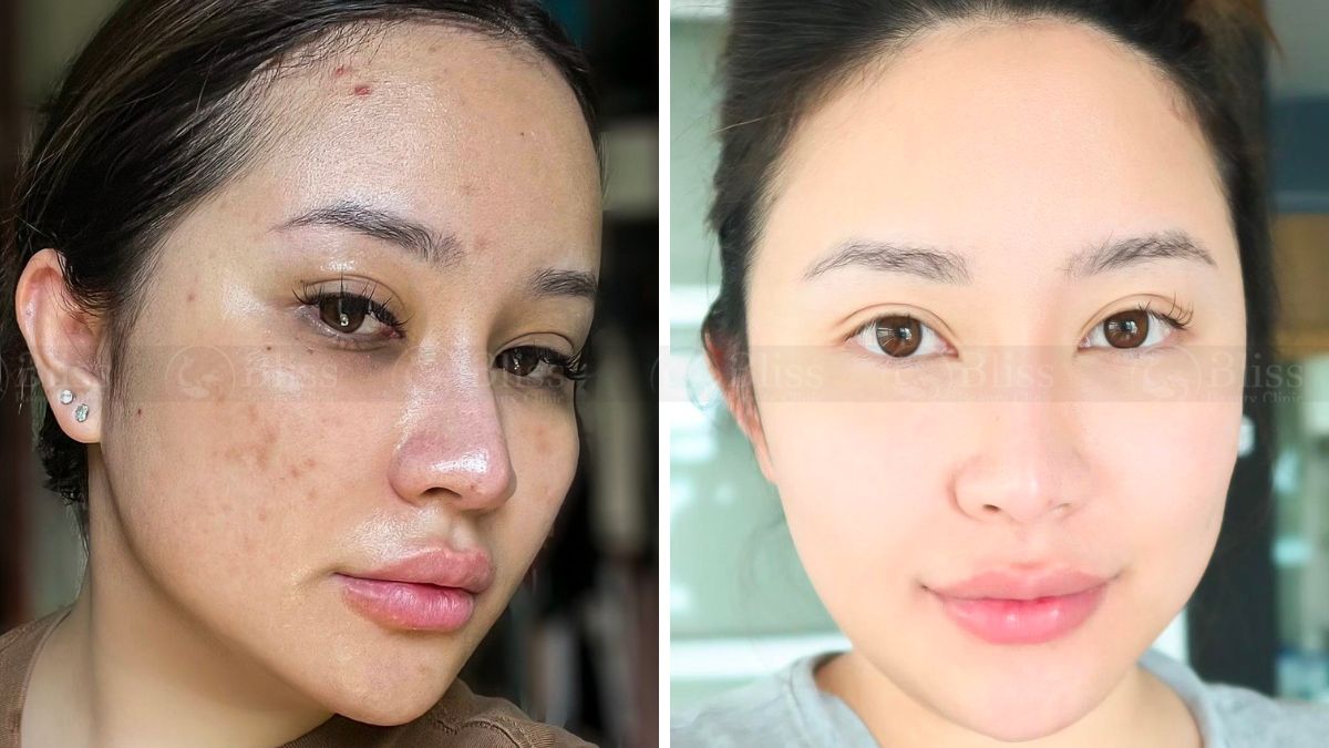 tiem-mesocell-extra-tri-mun-tham