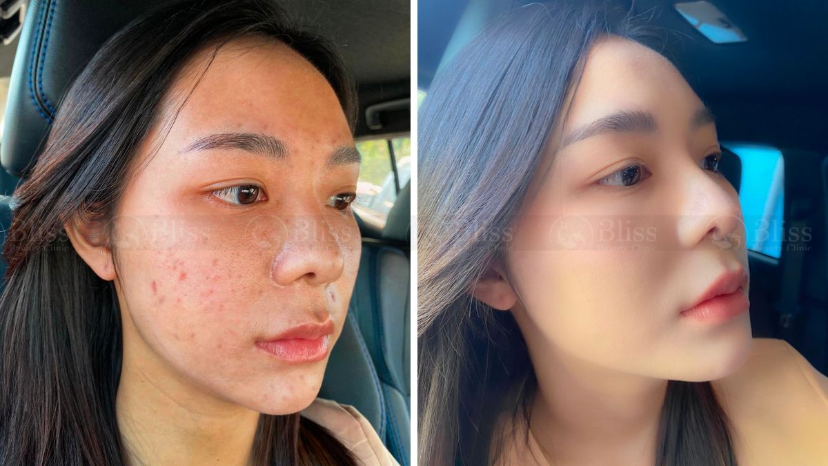 tiem-mesocell-extra-tri-mun-tham