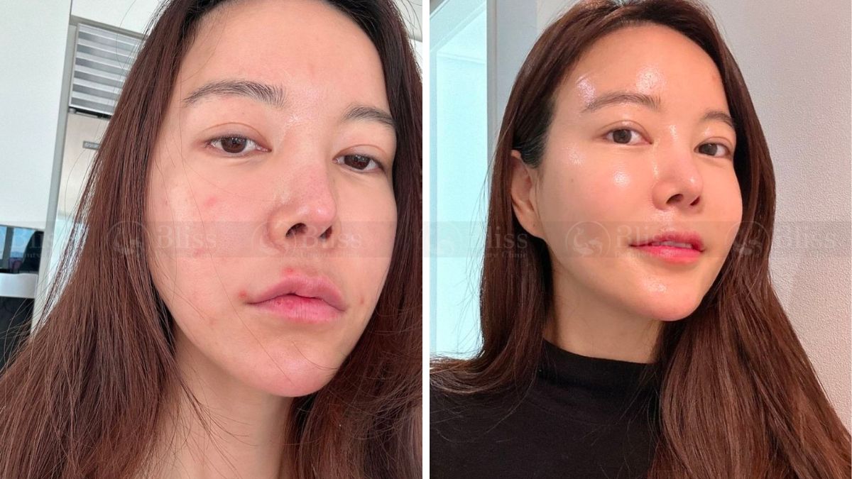 tiem-mesocell-extra-tri-mun-tham