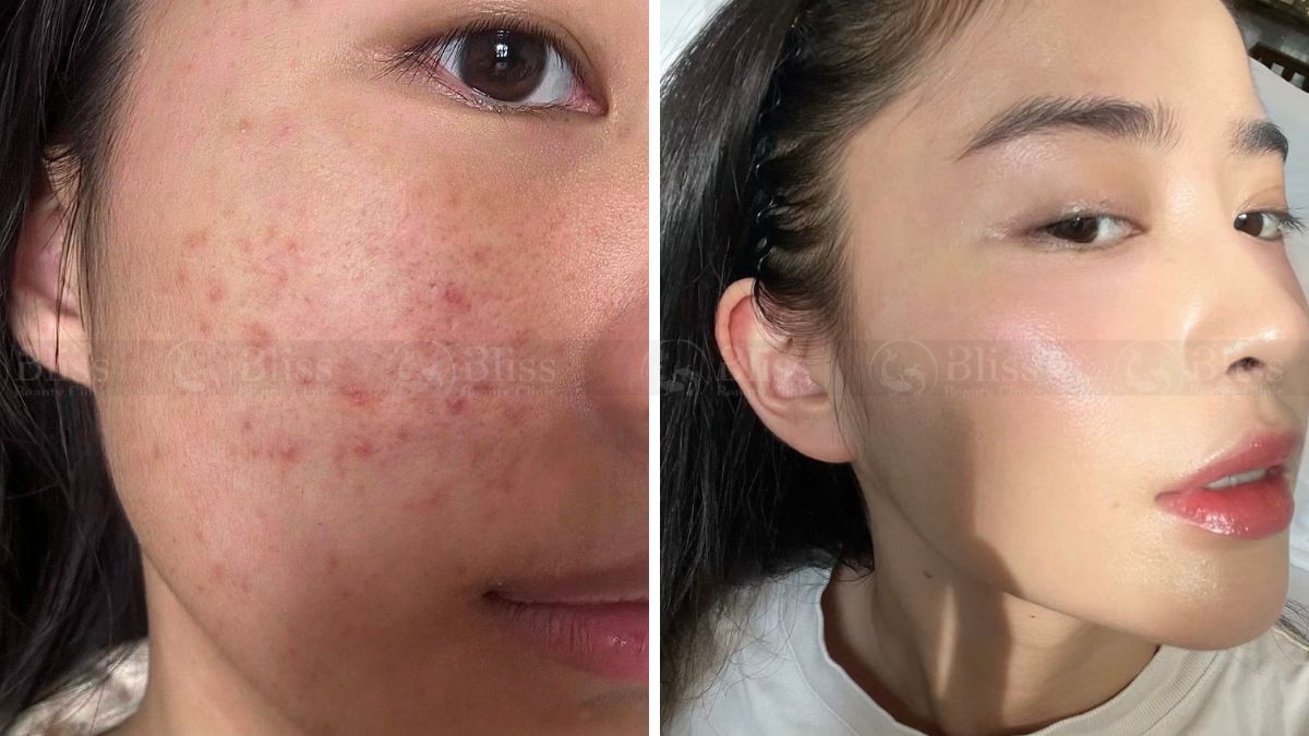 tiem-mesocell-extra-tri-mun-tham