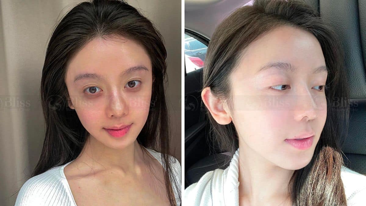 tiem-cang-bong-mesocell-extra