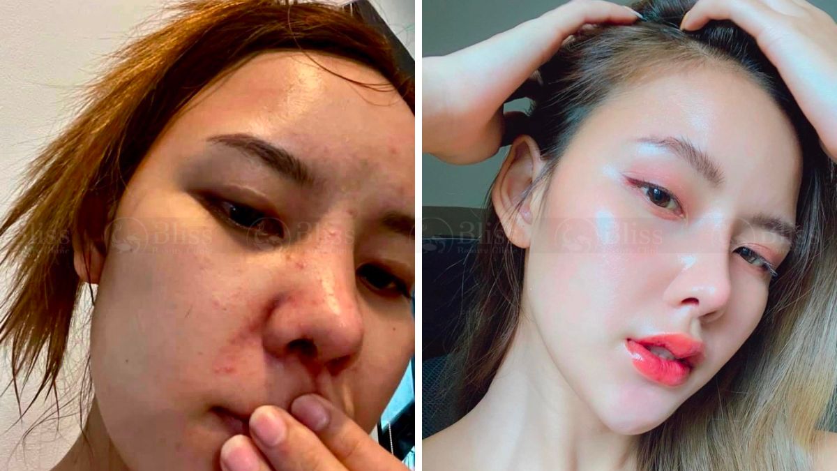 tiem-cang-bong-mesocell-extra