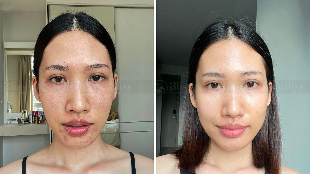 tiem-cang-bong-mesocell-extra