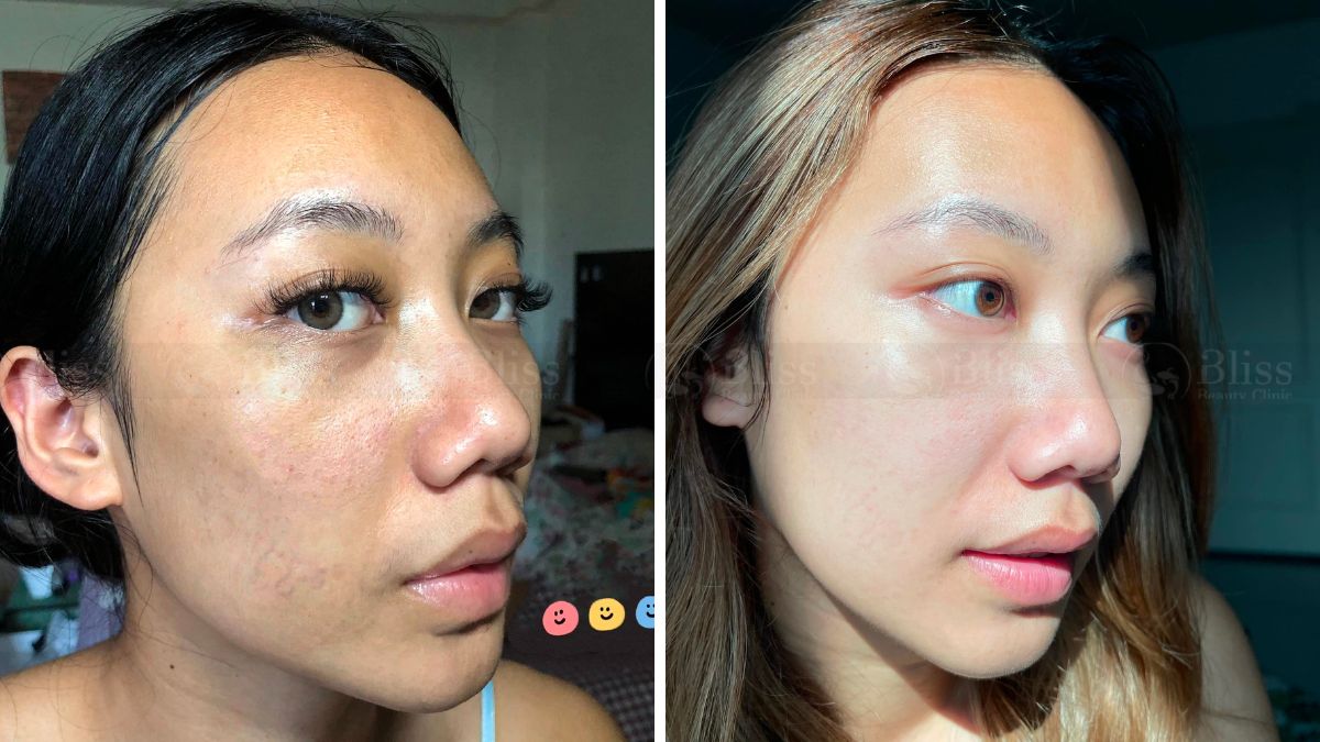 tiem-cang-bong-mesocell-extra