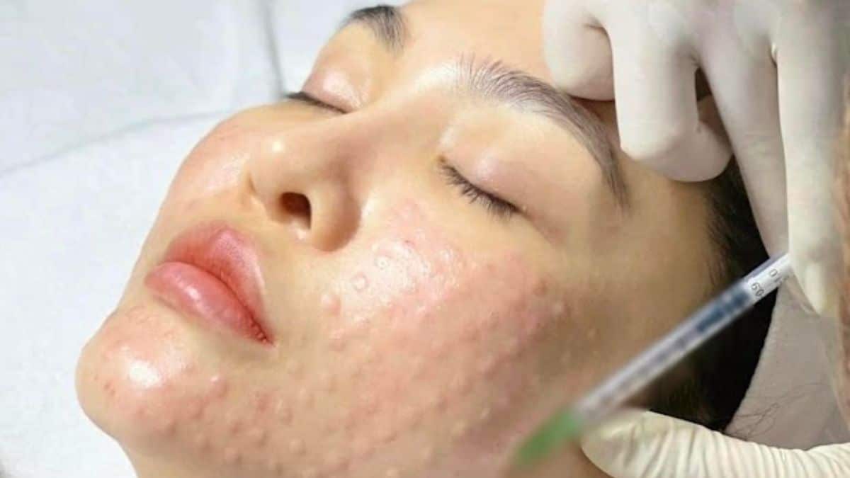 tiem-cang-bong-mesocell-extra