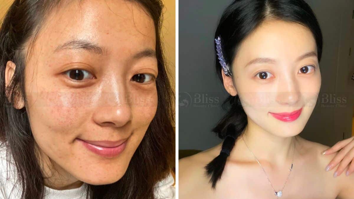 tiem-cang-bong-mesocell-extra