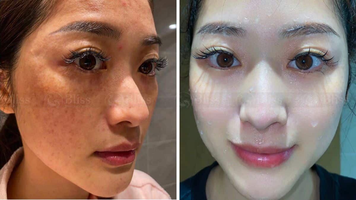 tiem-cang-bong-mesocell-extra