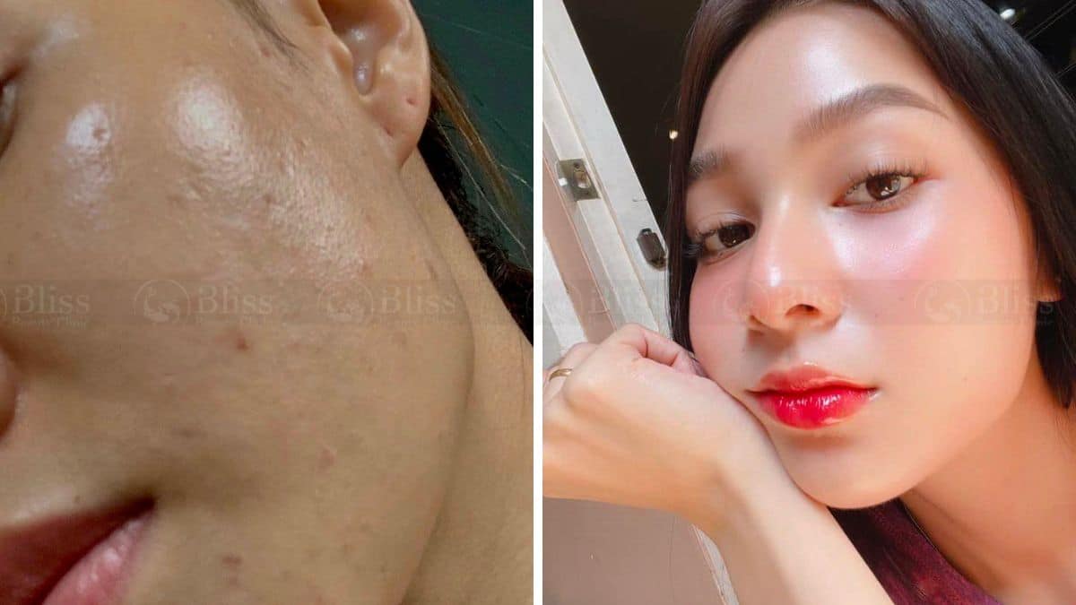 tiem-cang-bong-mesocell-extra