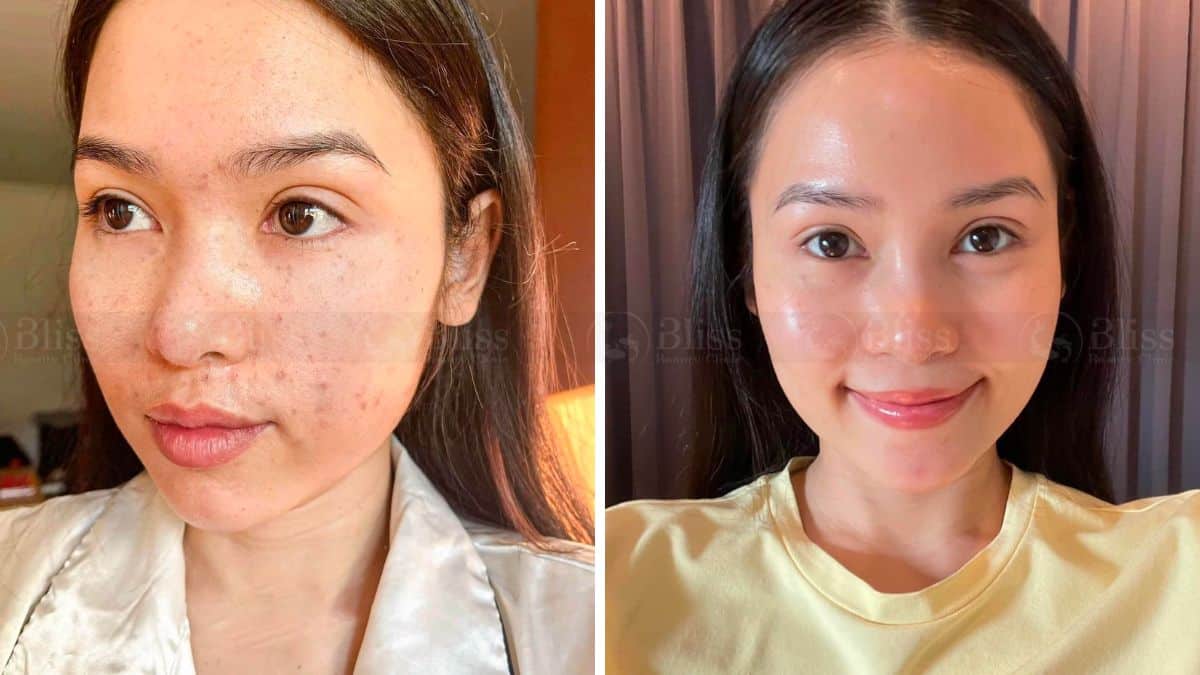 tiem-cang-bong-mesocell-extra