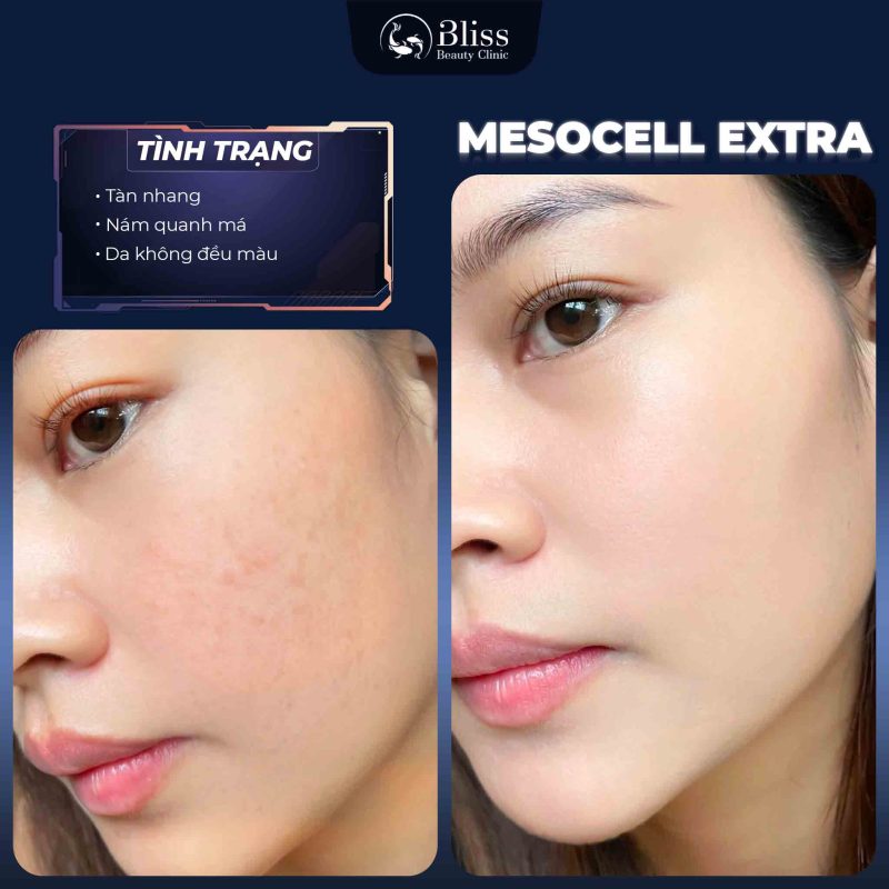 TIÊM MESOCELL EXTRA