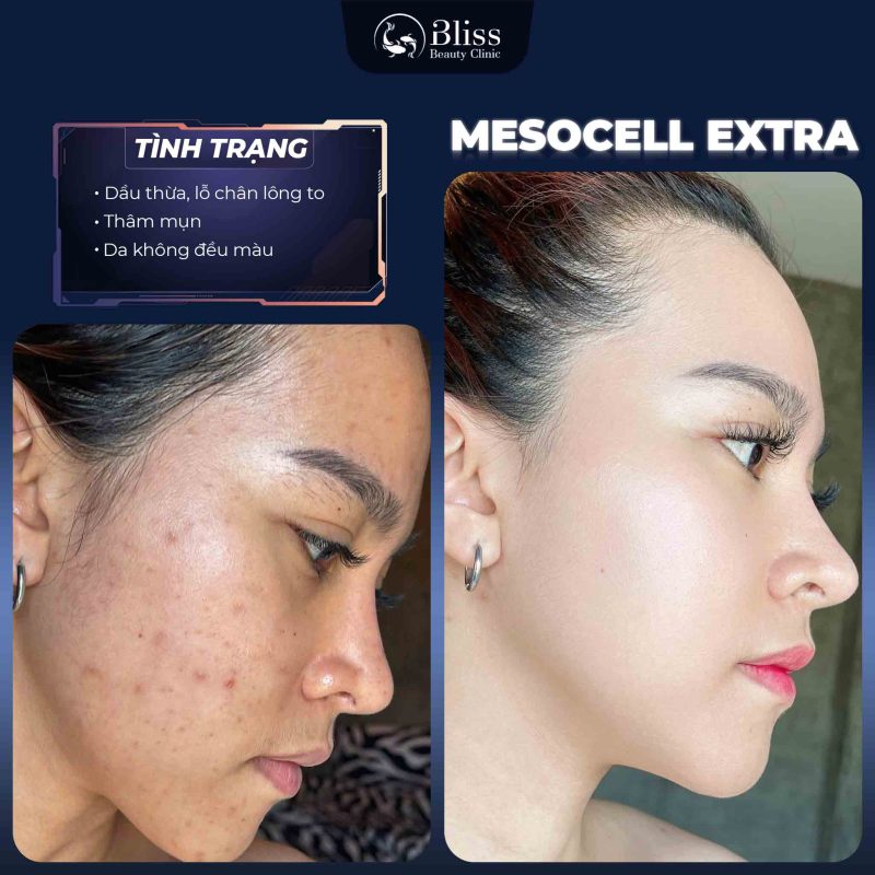 TIÊM MESOCELL EXTRA