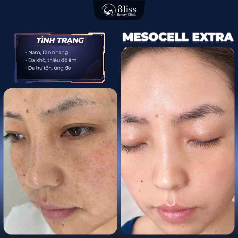TIÊM MESOCELL EXTRA