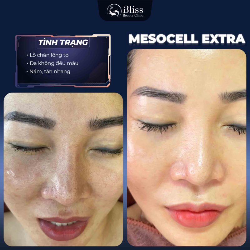 TIÊM MESOCELL EXTRA