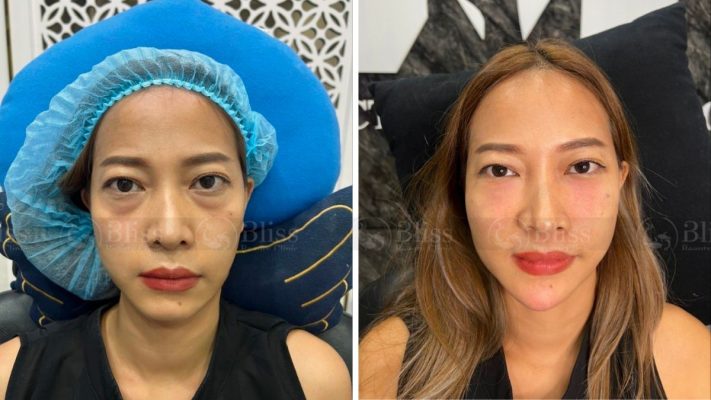 tiem-mesocell-extra-tri-tham-mat