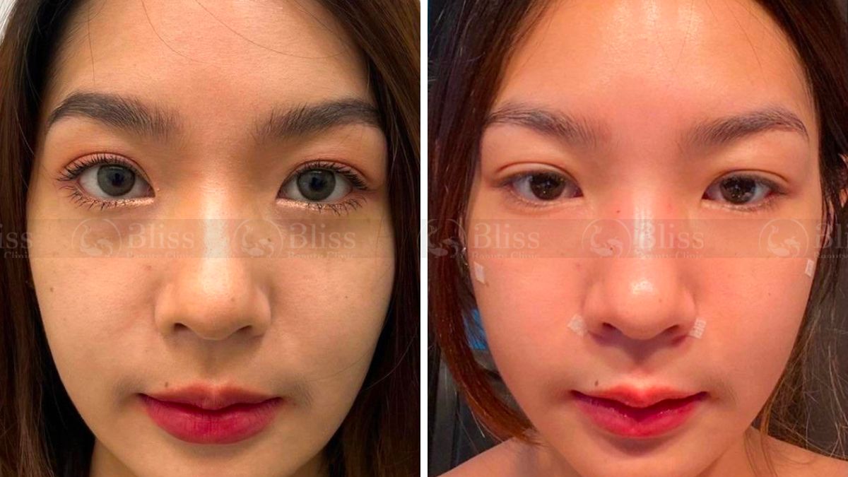 tiem-mesocell-extra-tri-tham-mat