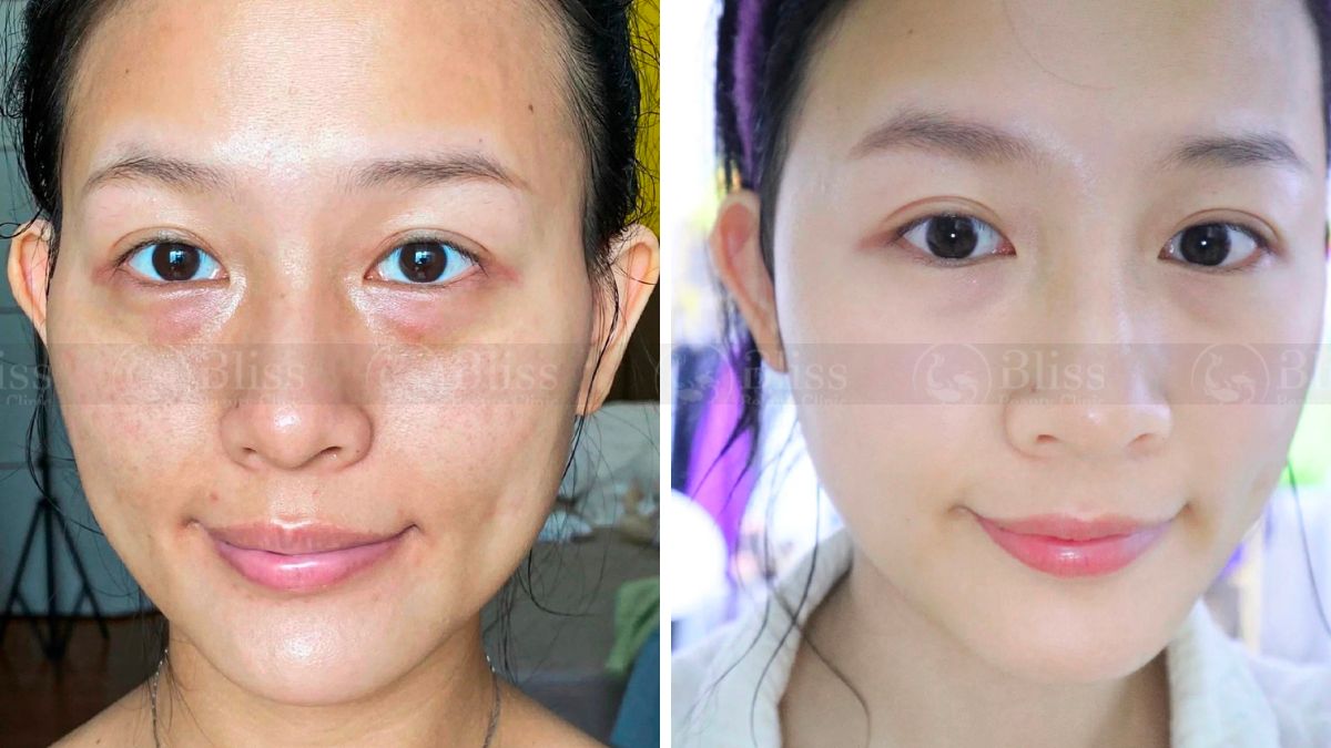 tiem-mesocell-extra-tri-tham-mat