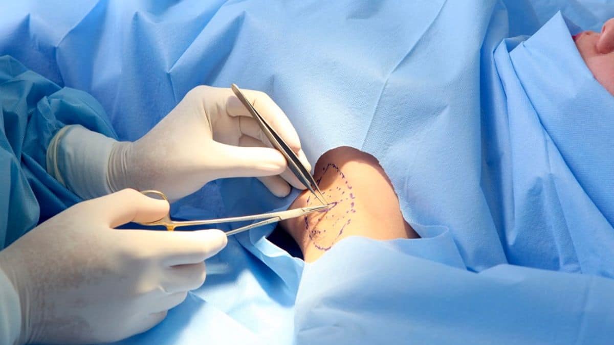 top-cac-phuong-phap-dieu-tri-hoi-nach