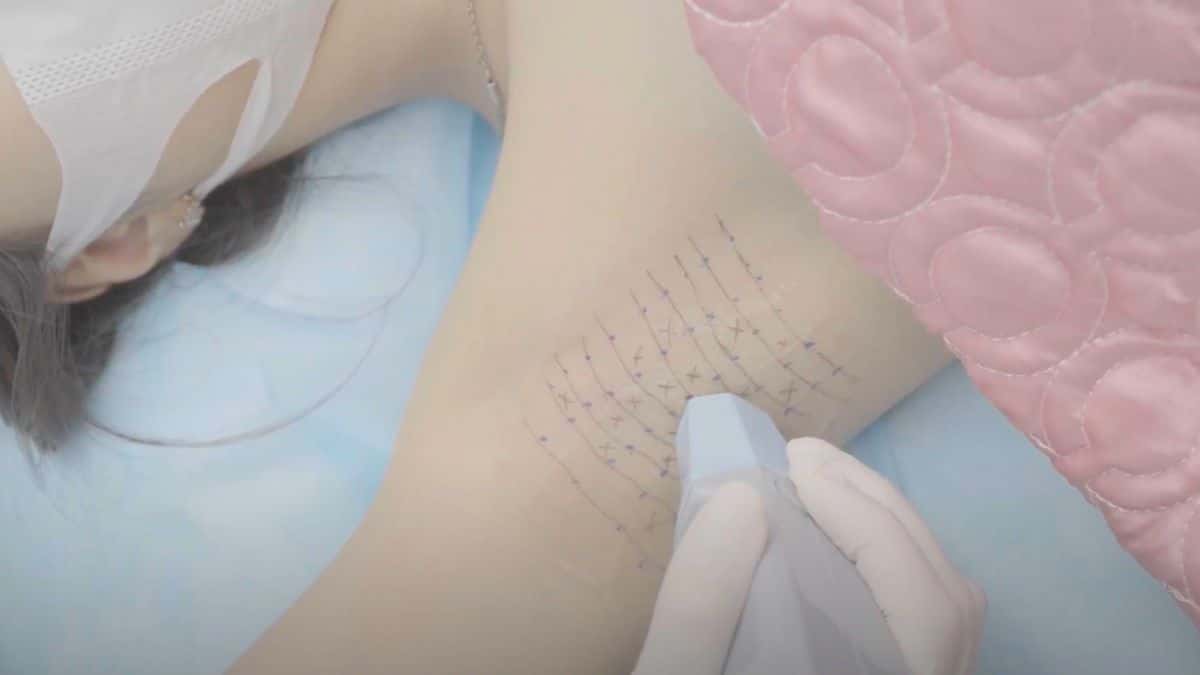 top-cac-phuong-phap-dieu-tri-hoi-nach