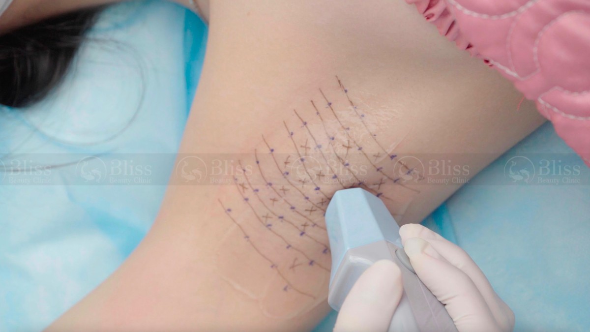 tri-hoi-nach-gia-re-khong-phau-thuat-go-vap