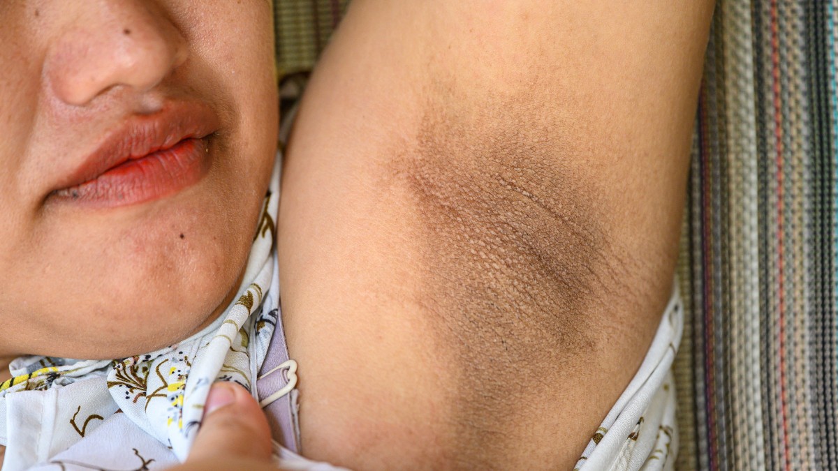 tri-hoi-nach-gia-re-khong-phau-thuat-go-vap