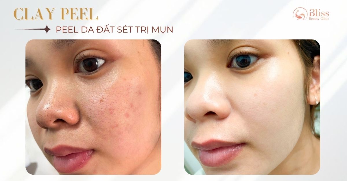 peel-da-dat-set-clay-peel-tri-mun