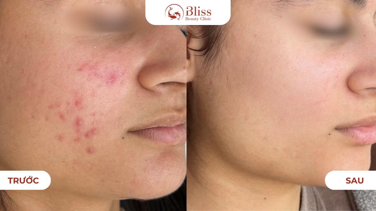 chấm mụn spot peel gom cồi tiêu viêm