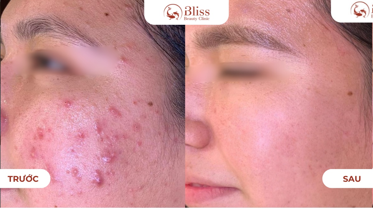 chấm mụn spot peel gom cồi tiêu viêm