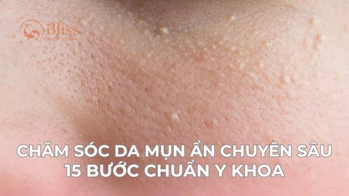 chăm sóc da mụn ẩn chuyên sâu