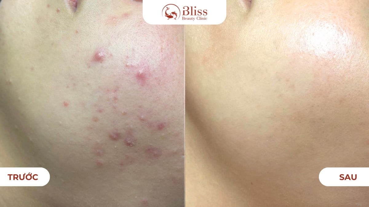 chăm sóc da mụn ẩn chuyên sâu