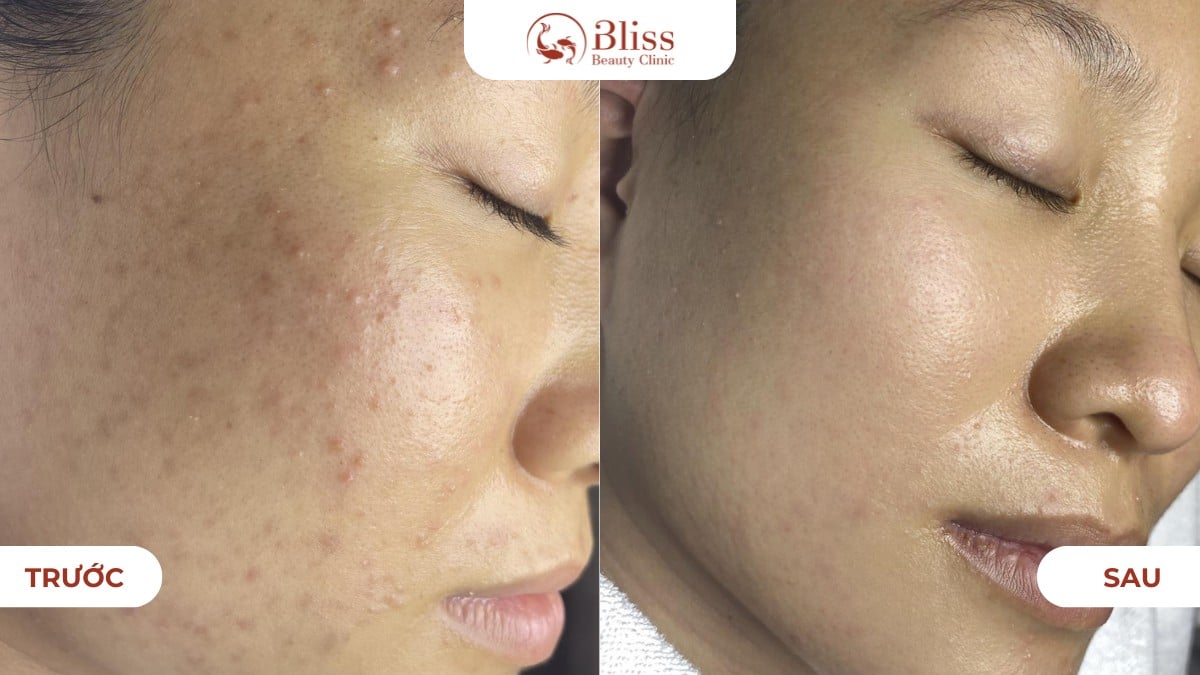 chăm sóc da mụn ẩn chuyên sâu
