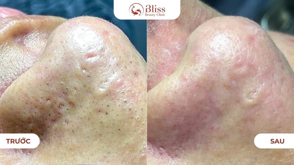 chăm sóc da mụn ẩn chuyên sâu