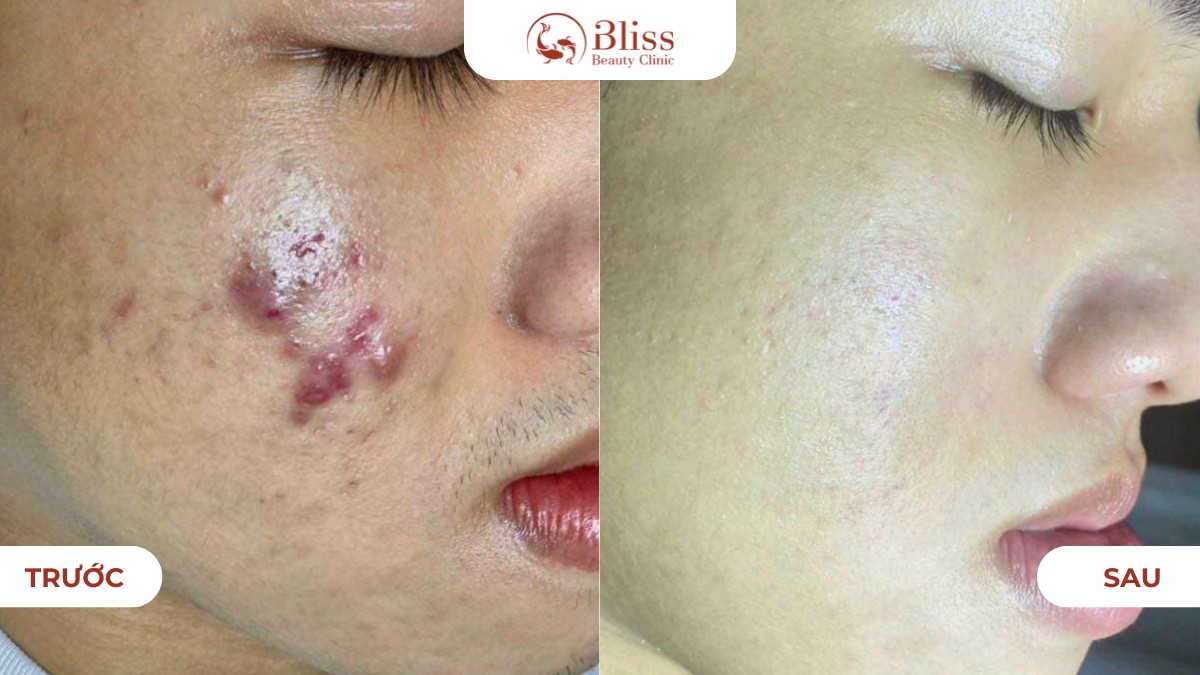 chăm sóc da mụn viêm