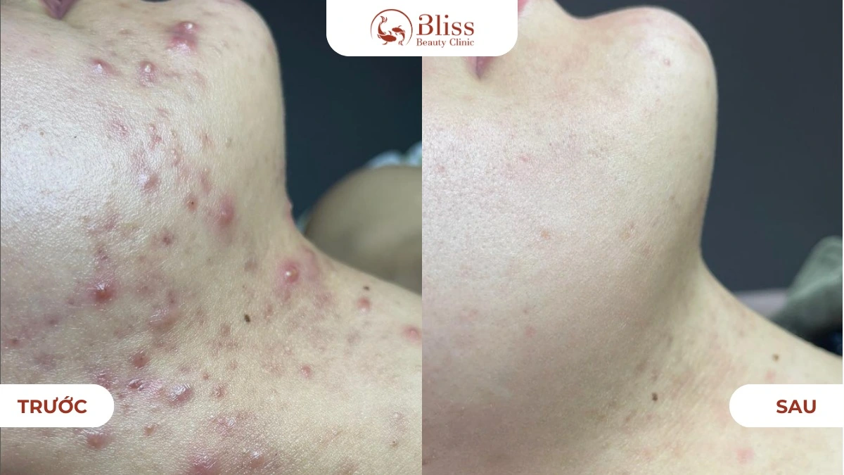 dich-vu-cham-soc-da-mun-cao-cap-acni-diamond