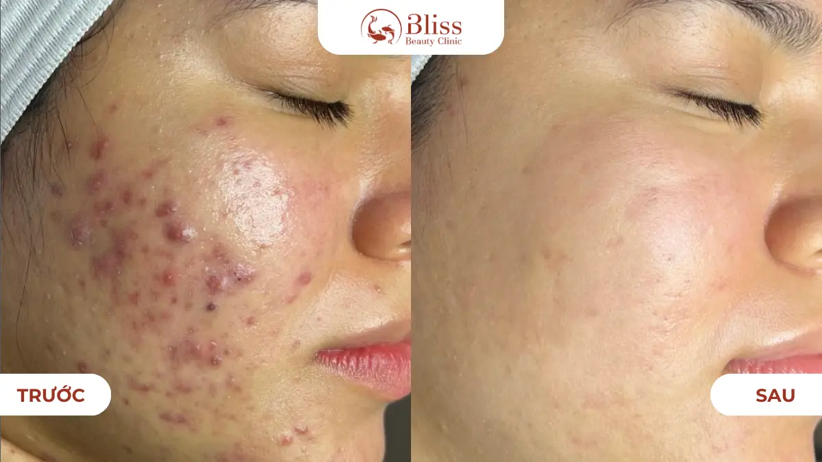 dich-vu-cham-soc-da-mun-cao-cap-acni-diamond