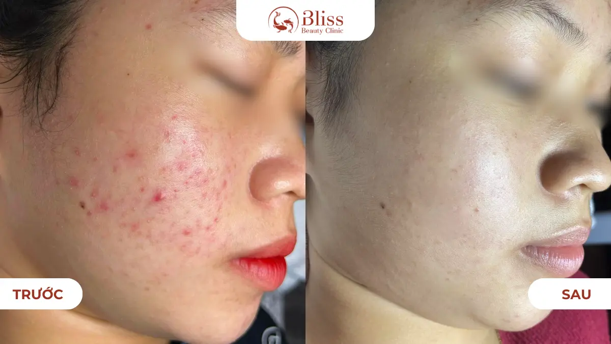 dich-vu-cham-soc-da-mun-cao-cap-acni-diamond