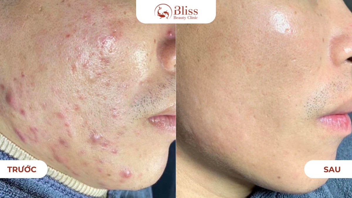 trị mụn dậy thì Acni Diamond