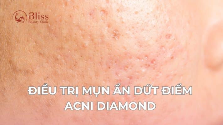 điều trị mụn ẩn dứt điểm acni diamond