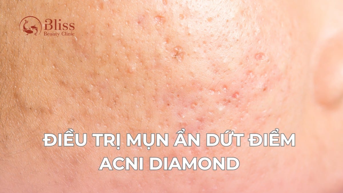 điều trị mụn ẩn dứt điểm acni diamond