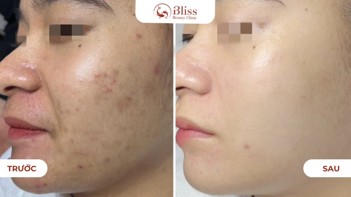 điều trị mụn ẩn dứt điểm acni diamond