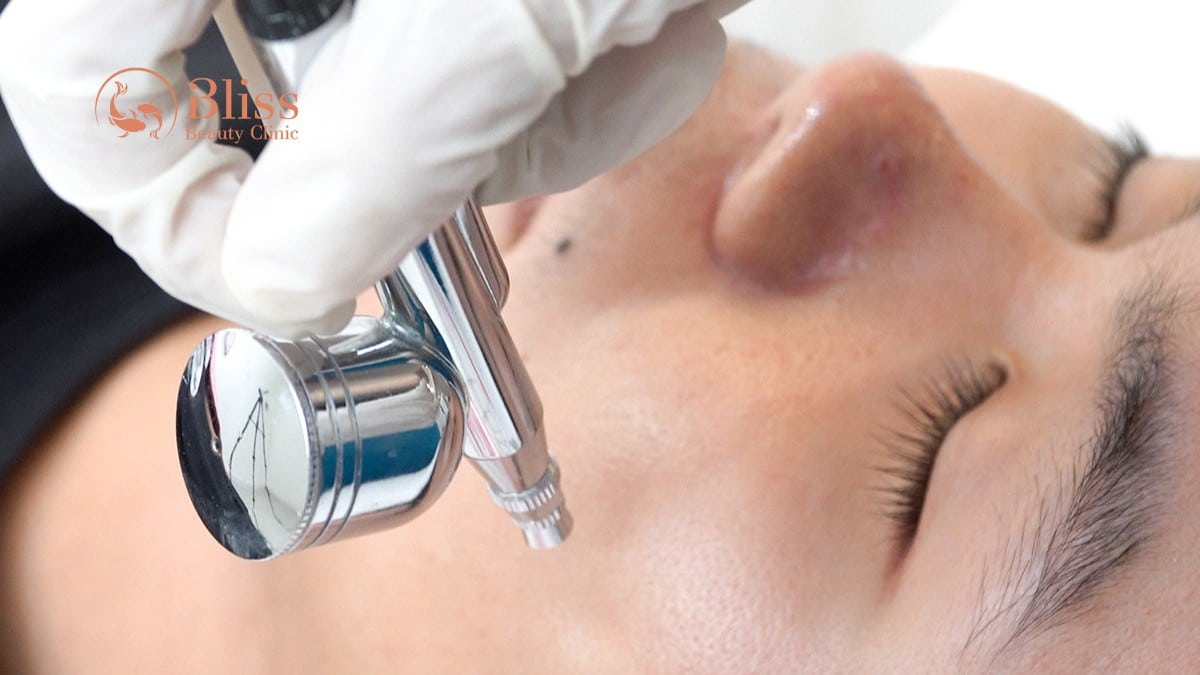 điều trị mụn ẩn dứt điểm acni diamond