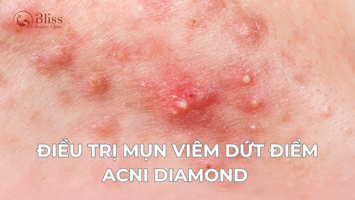 điều trị mụn viêm dứt điểm acni diamond