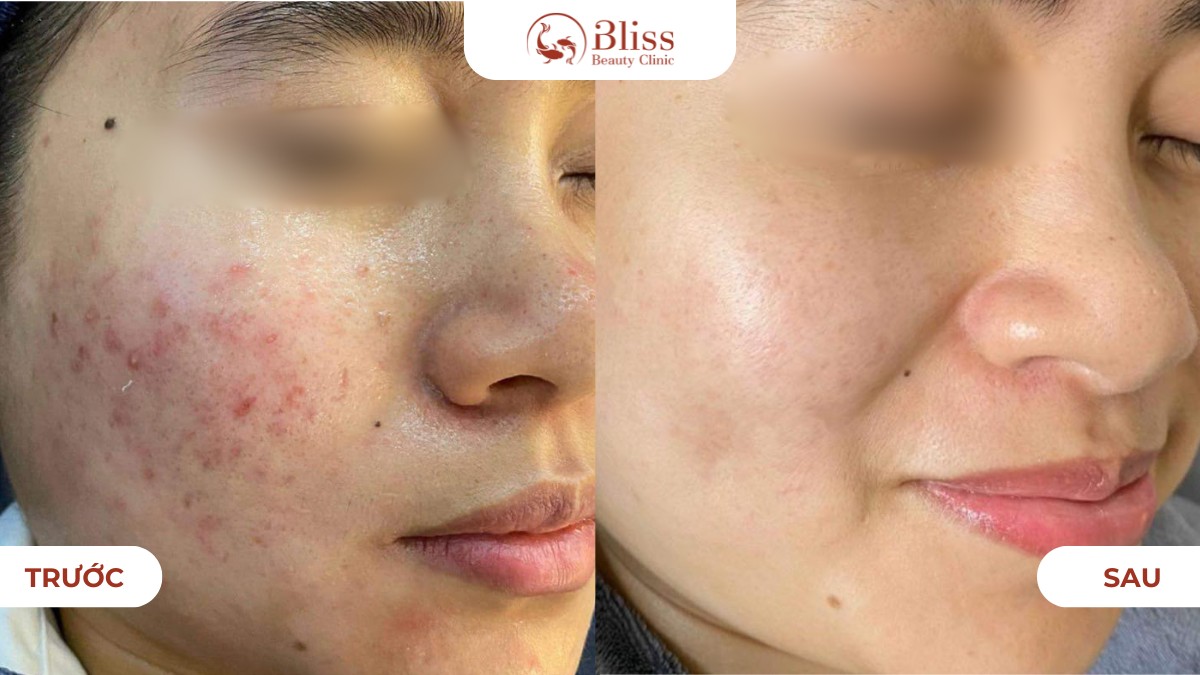 điều trị mụn viêm dứt điểm acni diamond