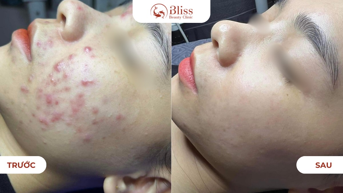 điều trị mụn viêm dứt điểm acni diamond