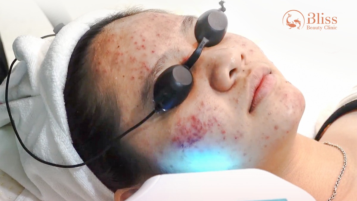 IPL trị mụn và kiểm soát nhờn
