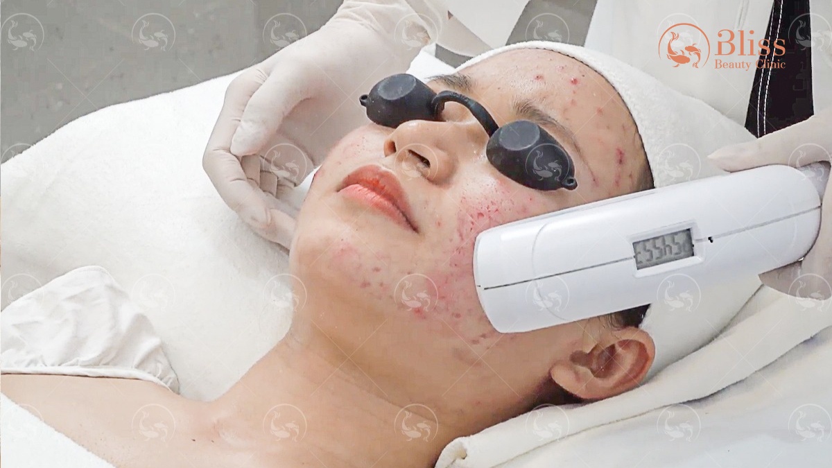 IPL trị mụn và kiểm soát nhờn