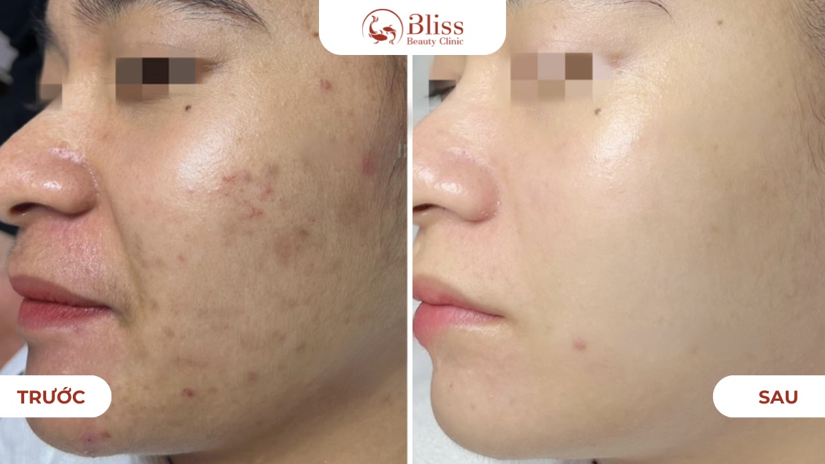 IPL trị mụn và kiểm soát nhờn