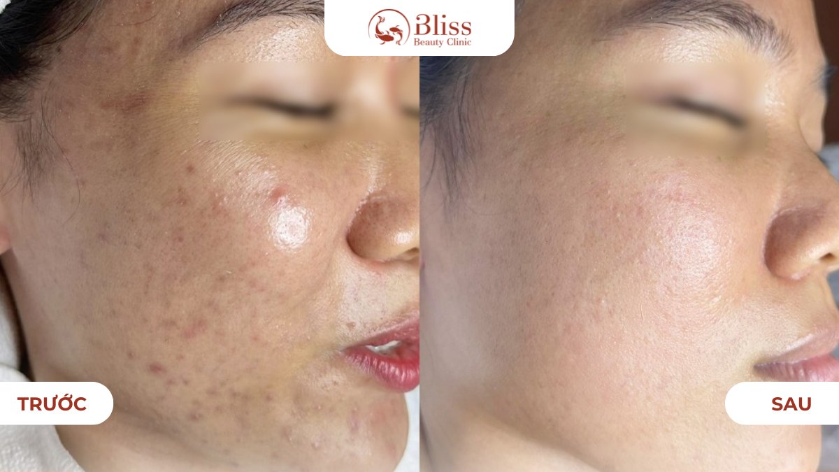 IPL trị mụn và kiểm soát nhờn