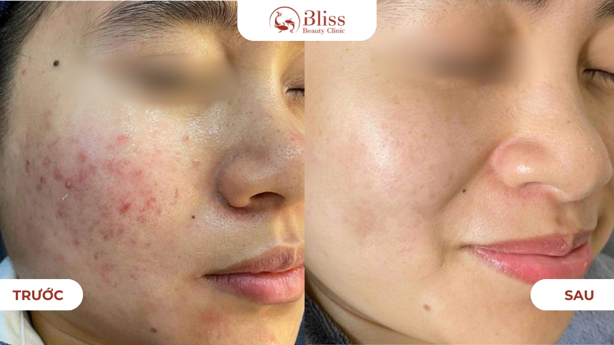 IPL trị mụn và kiểm soát nhờn