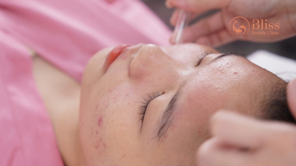 lấy nhân mụn 15 bước chuẩn y khoa